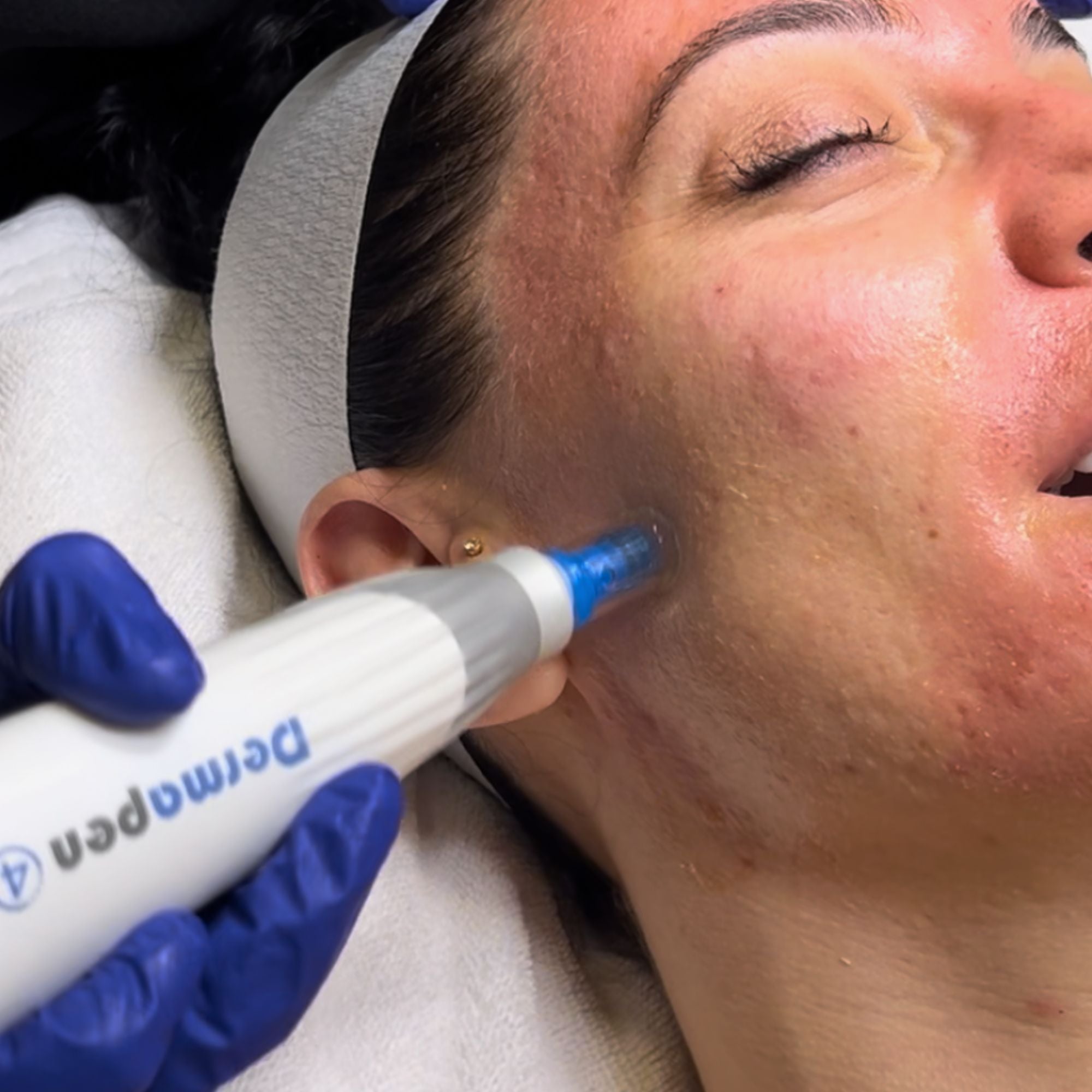 Exosomes Microneedling Skin Booster 4 Pack