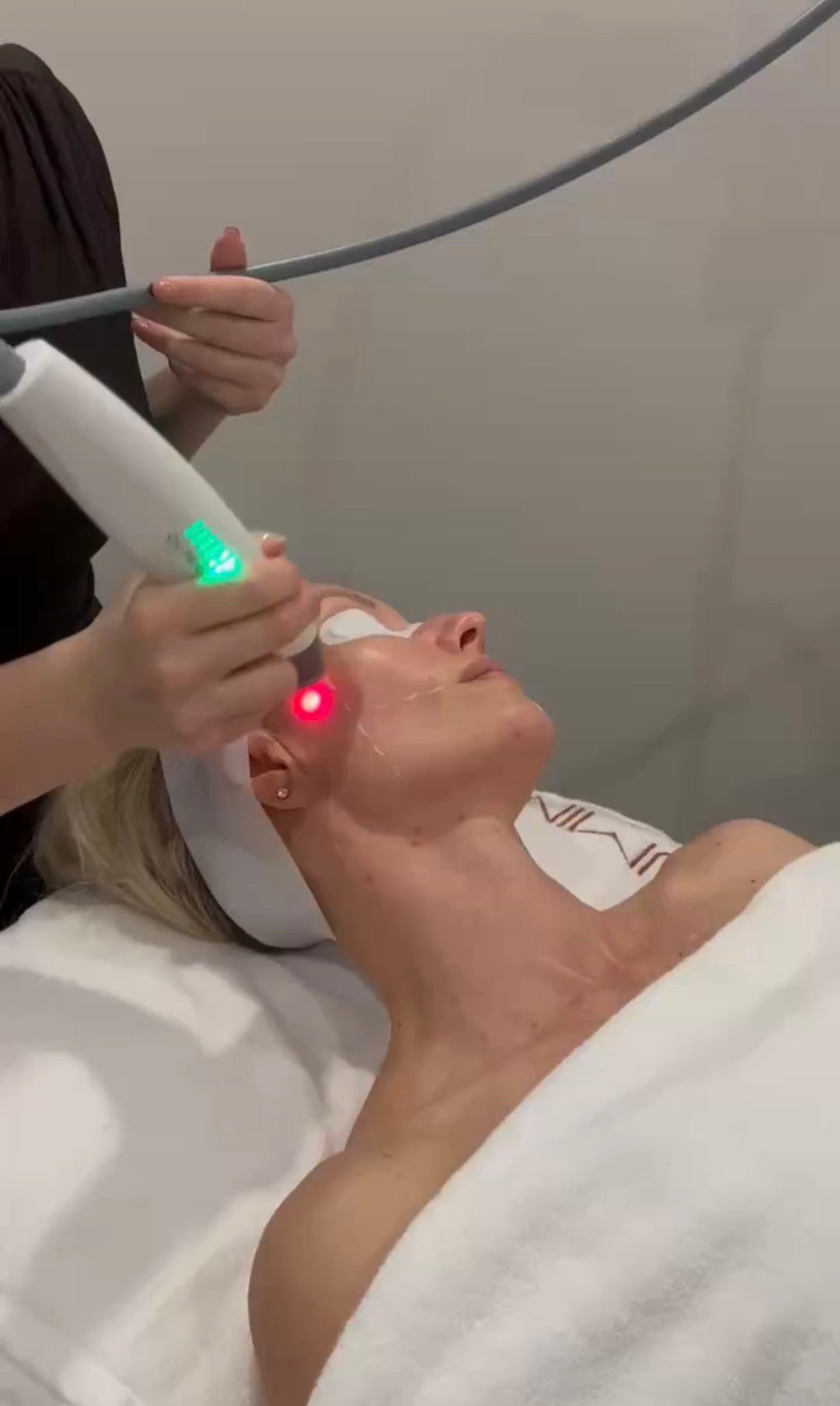 Laser Genesis x Skin Needling